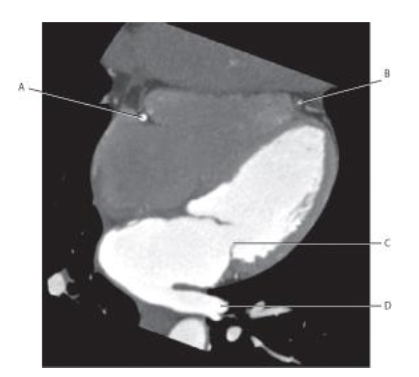 <p>Which line points to the <span style="color: yellow">left anterior descending artery</span>?</p>