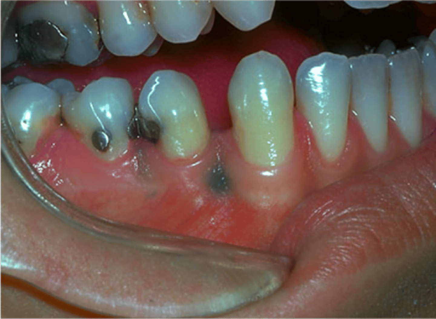 <p>confirmed through radiograph</p>