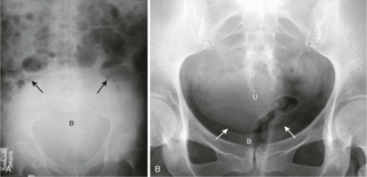 <p>usually appears at soft tissue mass, displacing bowel</p>