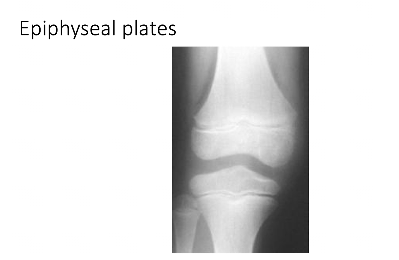 <p>C = Cartilage Spaces:</p><ul><li><p>What are the 3 main things that Epiphyseal Plates may show?</p></li></ul><p></p>