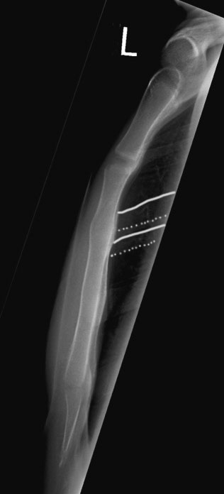 <p>Yes, Tilt. Anterior ribs should SI each other.</p>