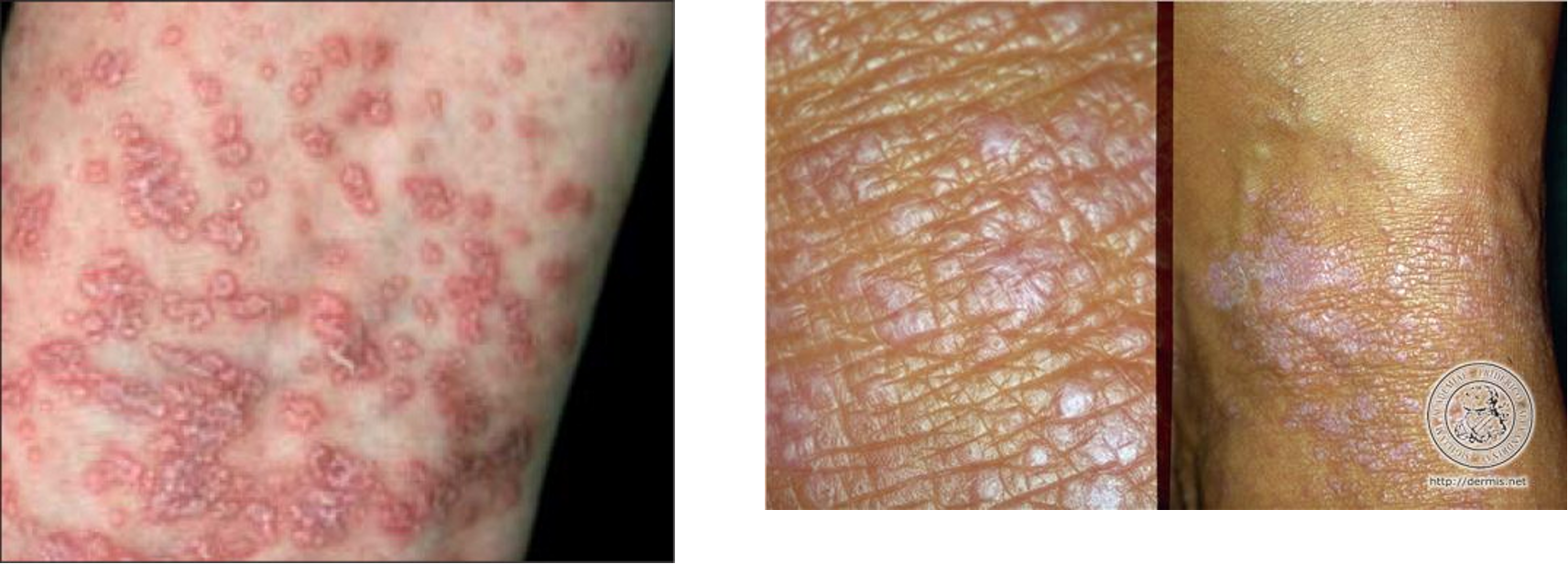 <p>lichen planus is an example of what pattern of inflammatory disease?</p>