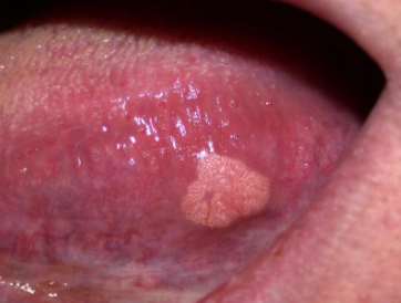 <p>hyperplastic spithelium with white/yellow/red papillary rough surface </p>