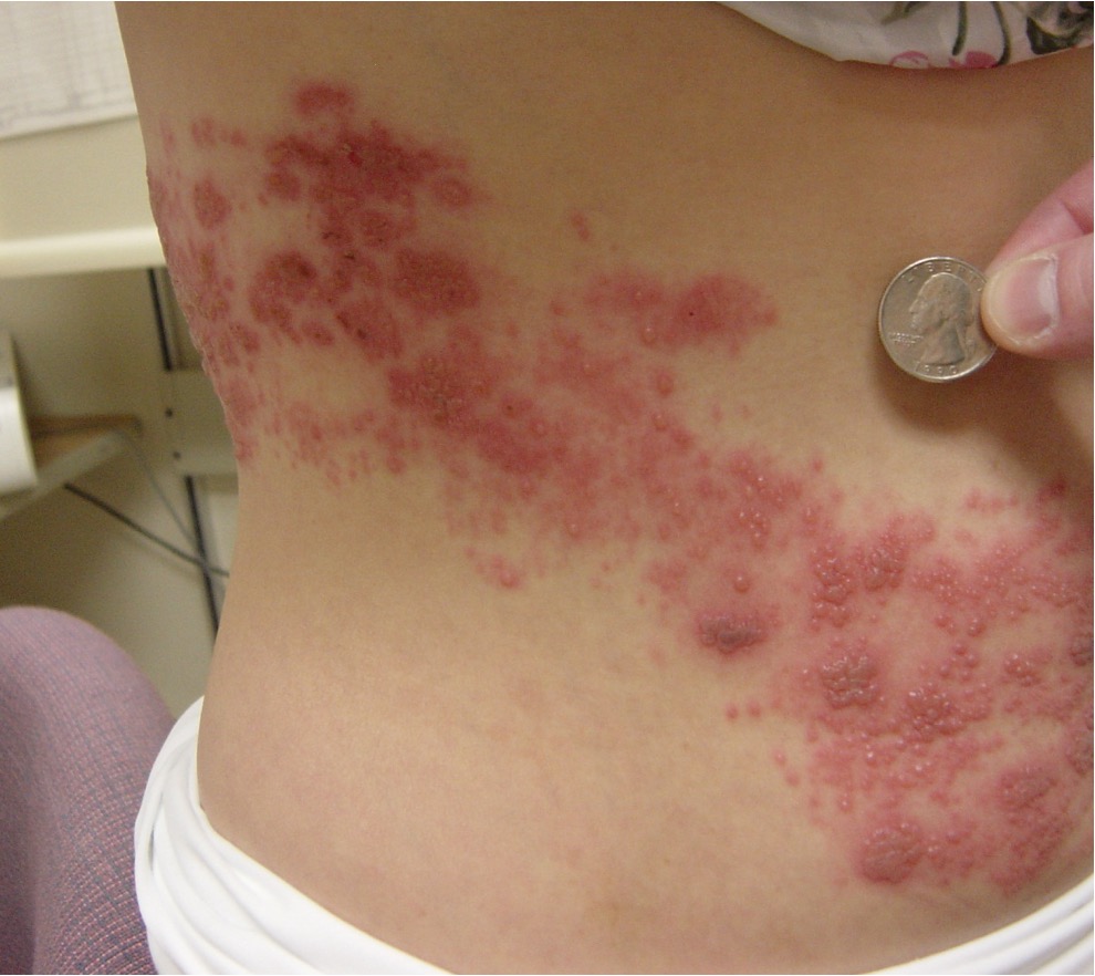 <p>What condition?</p><ul><li><p>reactivation of VZV</p></li><li><p>severe pain, may precede rash</p></li><li><p>skin lesions similar to chicken pox that follow nerve root distribution (T &amp; L roots MC) → maculopapules evolve into vesicles/pustules</p></li><li><p>hutchinson’s sign → lesions on tip of nose, indicates ophthalmic division dz</p></li></ul><p></p>