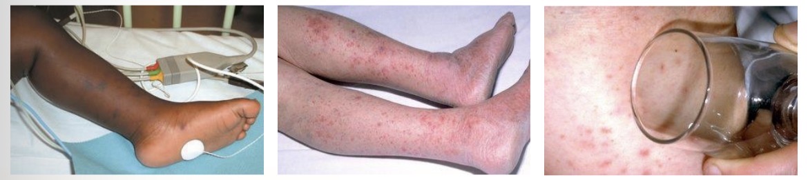 <ul><li><p>Starts as small red pinpricks, spreads quickly to become red or purple blotches anywhere on the body</p></li><li><p>Non-blanching rash - doesn’t fade or lose colour if pressed with the side of a clear drinking glass firmly against the rash</p></li><li><p>Darker skin - check paler areas of the body</p></li><li><p>Balancing rash can develop into a non-blanching rash as illness progresses</p></li><li><p>Medical emergency - call 999 immediately</p></li></ul><p></p>