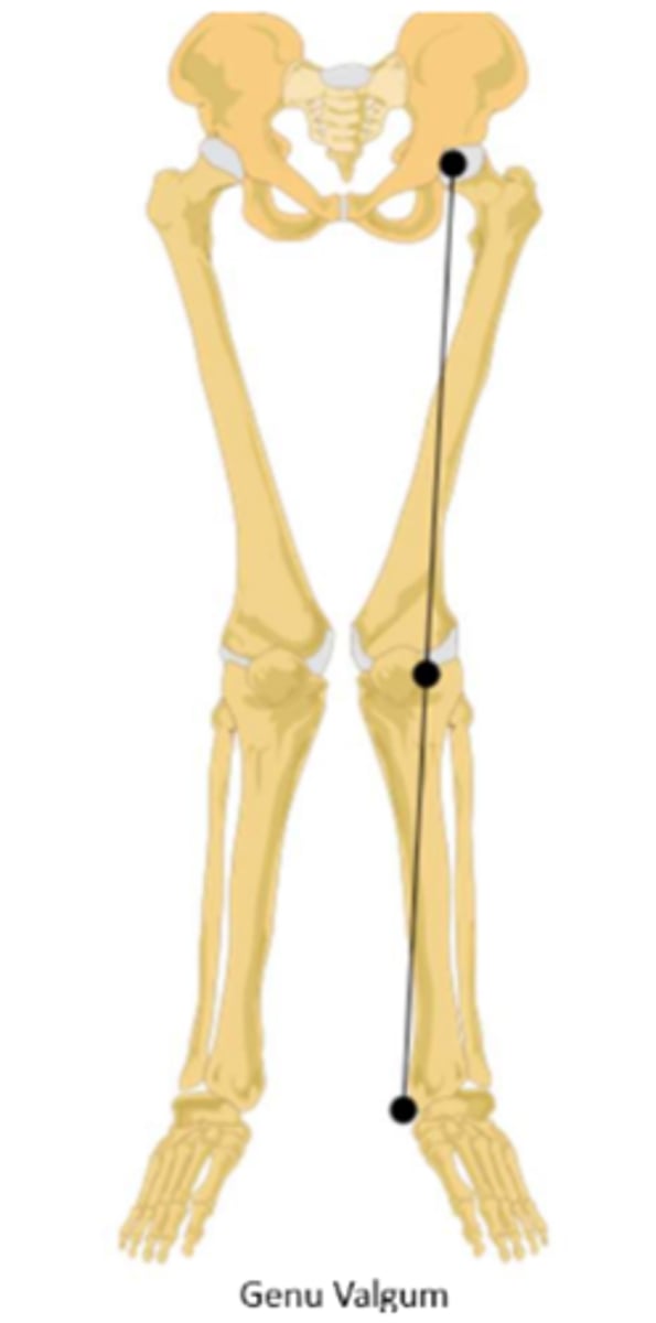 <p>"knock-knee"; femoral shaft lies more obliquely and results in a Q-angle greater than 15 degrees</p><p>lateral condyles take increased load</p><p>increase susceptibility to patellofemoral syndrome because quadriceps tendon may pull patella laterally</p>
