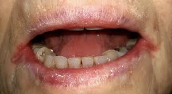 <p>what is this condition and what vitamins is this person likely deficient in?</p>