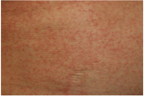 <p>scabies</p>