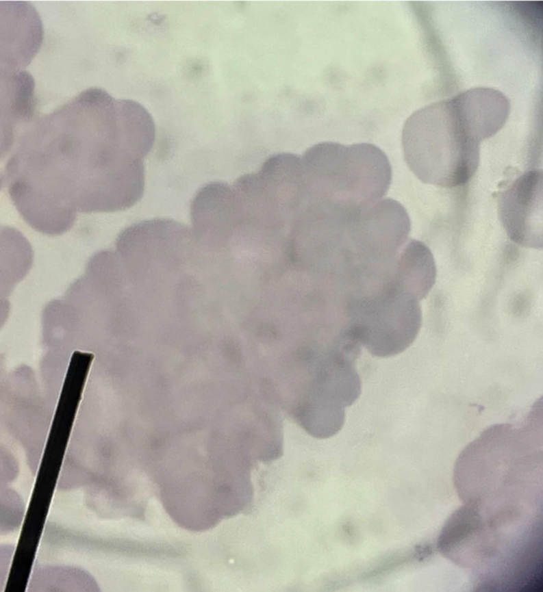<p>A. Identify the pointed cell</p><p>B. Describe the striking feature</p><p>C. Associated with what conditions?</p><p>D. Common cause of the cell’s formation?</p><p>E. Remedy of this finding.</p>