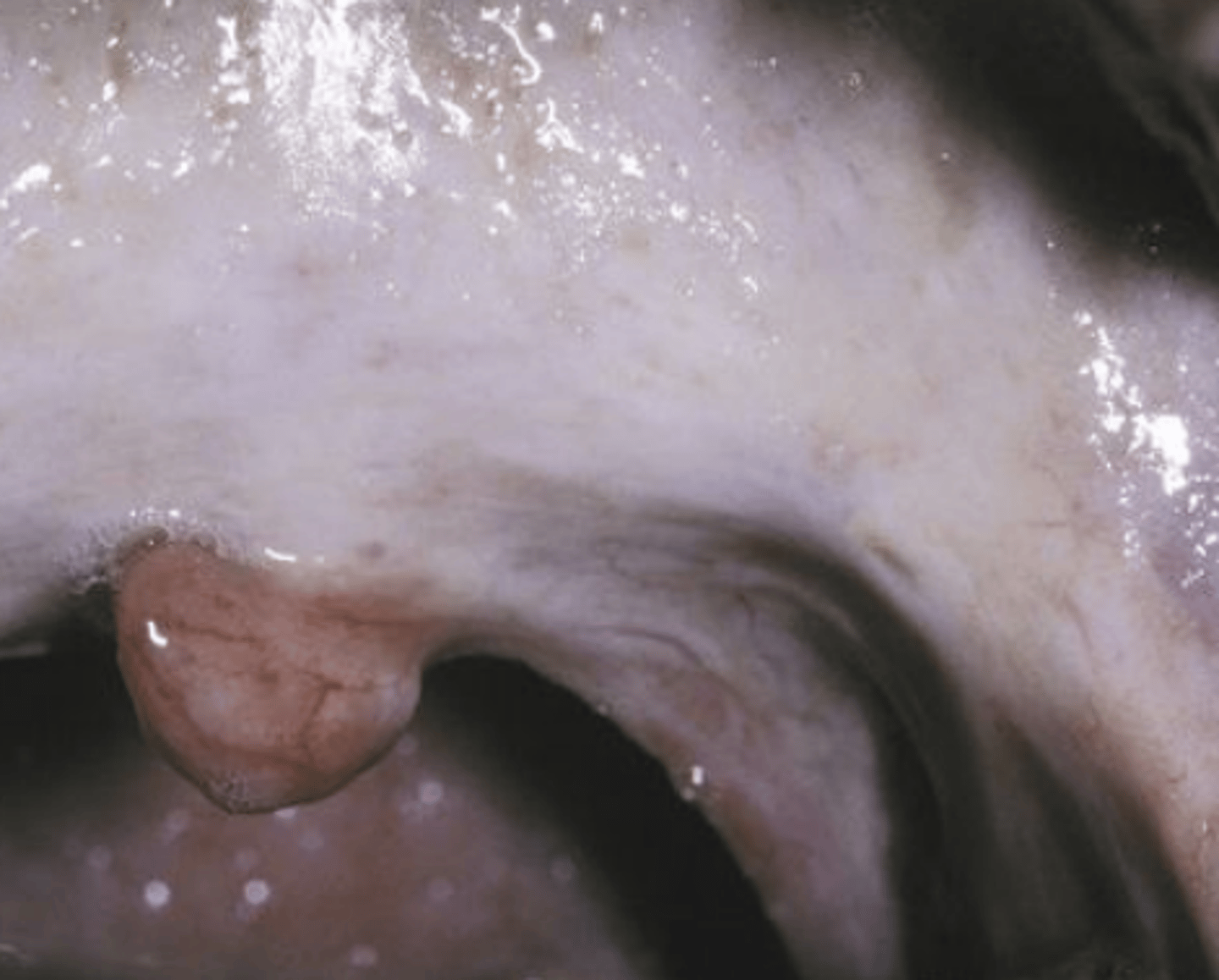 <p>Petechiae</p><p>Vesicles</p><p>Xerostomia</p><p>Melanosis</p><p>Blotchy, Marble-like appearance</p><p>might be able to feel fibrous bands</p>