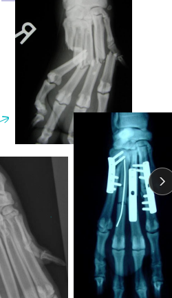 <ul><li><p>Very common, greyhounds</p></li><li><p><span style="background-color: transparent;"><strong><span>Carpal: </span></strong><span>lag screw</span></span></p></li><li><p><span style="background-color: transparent;"><strong><span>Metacarpal and Metatarsal:</span></strong><span> </span><u><span>medical tx most common</span></u></span></p><ul><li><p><span style="background-color: transparent;"><strong><span>Tx: </span></strong><u><span>closed reduction + caudal splint (Rx #1),</span></u><span> IM pins/plates + caudal splint (Sx)</span></span></p><ul><li><p><span style="background-color: transparent;"><strong><span>Sx indicated if open, grossly displaced</span></strong><span>, intra-articular, or all 4 fractured</span></span></p></li></ul></li></ul></li><li><p><span style="background-color: transparent;"><strong><span>Digital:</span></strong><span> caudal splint bandage for 6w</span></span></p></li></ul><img src="https://knowt-user-attachments.s3.amazonaws.com/0b8ab3d7-89ad-46d1-a71d-0b38d98c65b3.png" data-width="50%" data-align="center"><p></p>