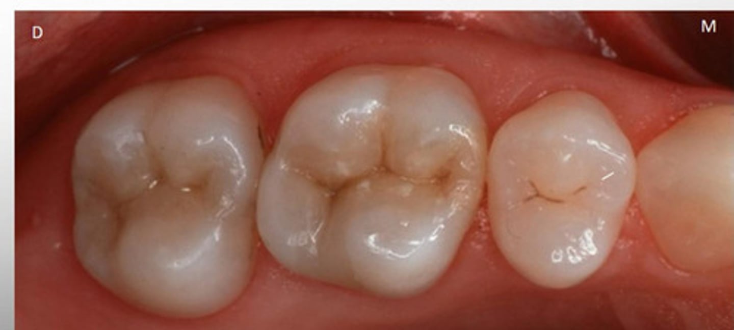 <p>Chewing surface of posterior teeth found within cusp and marginal ridges</p>