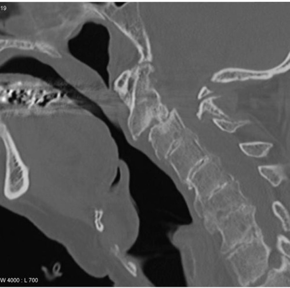 <p>Where can odontoid erosions affected synovial joints?</p>
