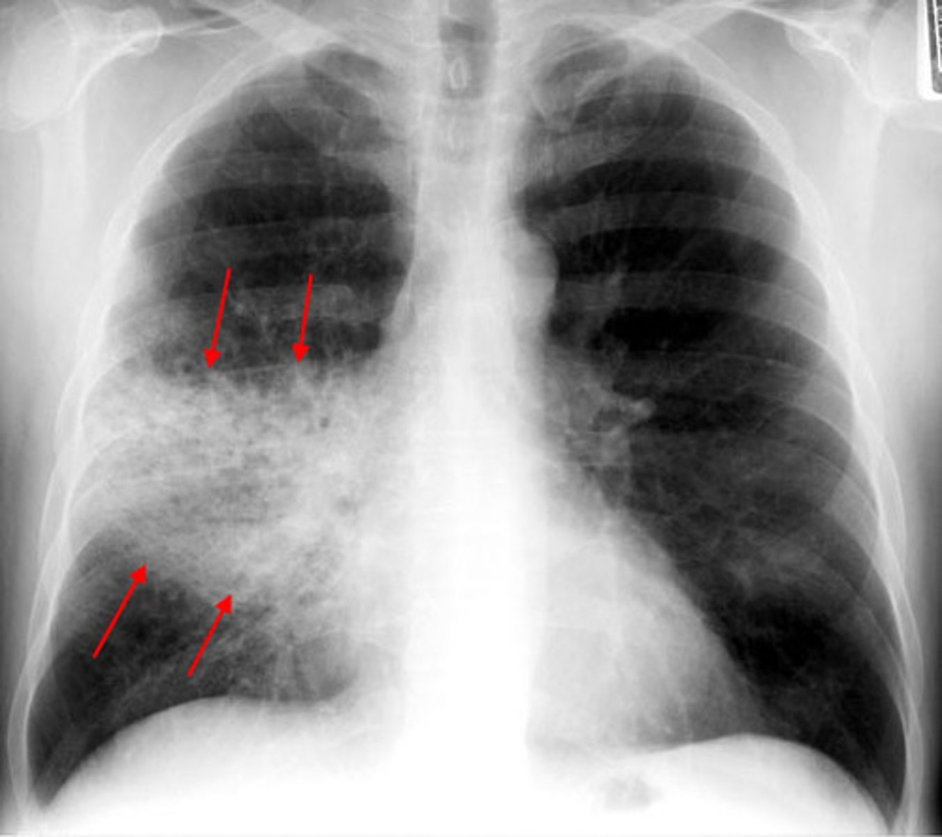 <p>Pathogen: Streptococcus pneumoniae</p><p>S+S: Inflammation of the alveoli in one or both lungs --&gt; Rapid onset of chest pain, dyspnea, high fever, productive cough</p><p>X-Ray: Looks equal to S+S severity - lobar involvement</p><p>Transmission: Inhalation of or contact with infected oropharyngeal secretions</p>