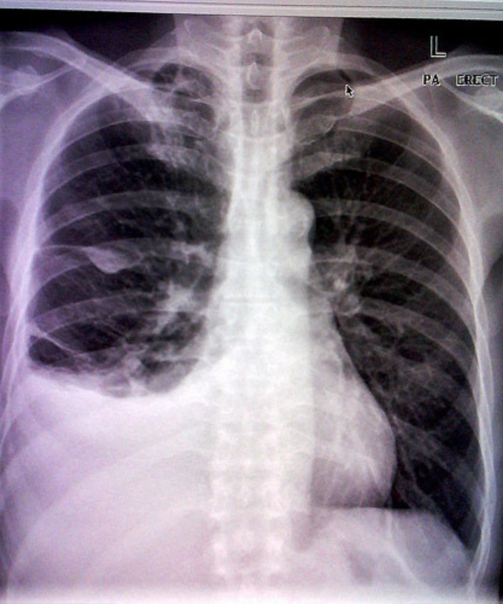 <p>-Pleural effusion</p><p>-Ascites</p><p>-osteopetrosis</p><p>-osteoscleoris</p><p>-Edema</p><p>-Increase technique</p><p>-*Fluid is heavier*</p>