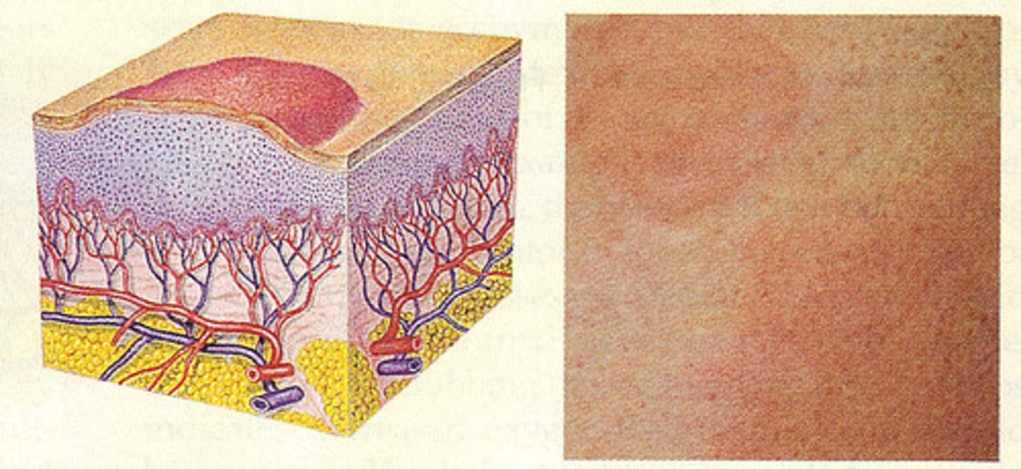 <p>Irregular, transient, superficial area of localized skin edema</p>