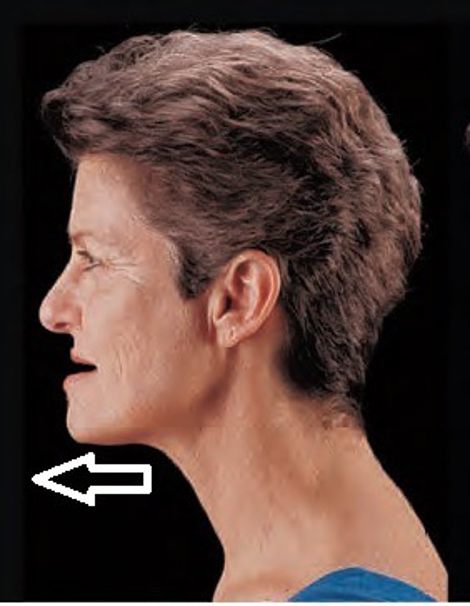 <p>Anterior movement of the mandible.</p>