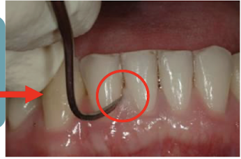 <p>tissue to blanch </p>