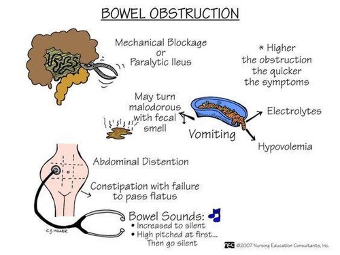 <p>A mechanical or non-mechanical occlusion of the lumen of the small intestine.</p>