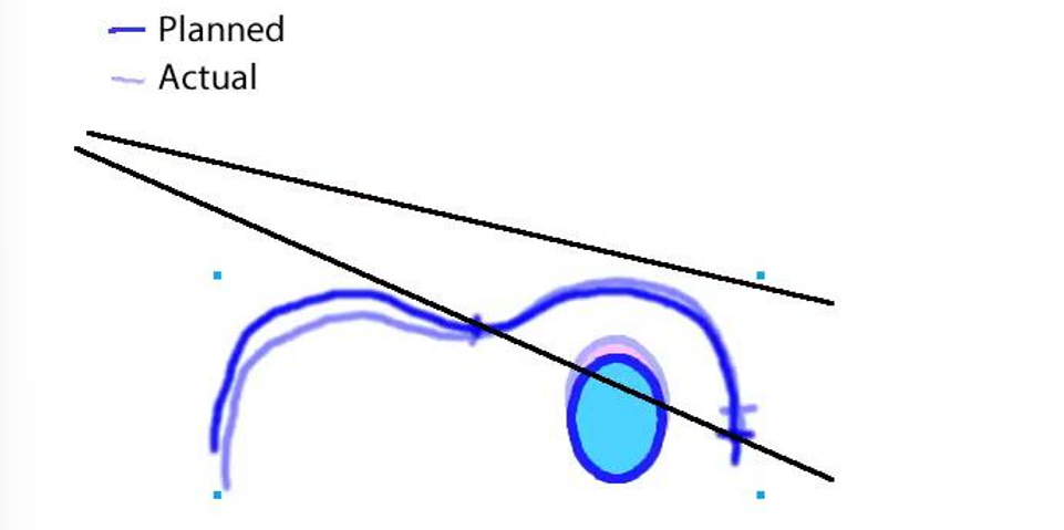 <p>the patient was set up with a roll: the patient’s treatment side was elevated</p><ul><li><p>the volume of lung receiving radiation has increased</p></li></ul><p></p>