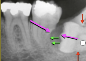 <ul><li><p>Size of <strong>Follicular space</strong></p></li><li><p>Location of <strong>Cortex relative to CEJ</strong></p></li><li><p><strong>Resorbed root 18</strong></p></li><li><p><strong>Impacted Tooth</strong></p></li></ul><p></p>