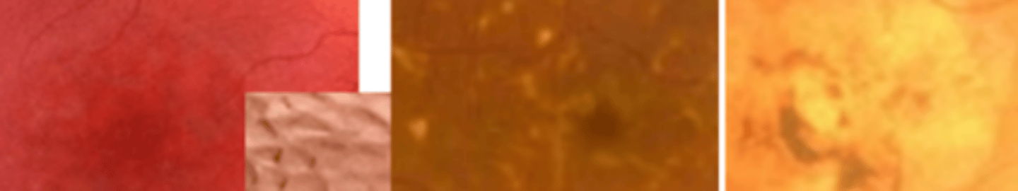 <p>CONE rod dystrophy which is an autosomal recessive disease causing a mutation of the ABCA4 gene. Presents as bilateral gradual impairment of central vision in the 1st to 2nd decade which may be out of proportion to macular changes which may be appointed to malingering since patients are young. Poor prognosis with no treatment. Genetic counseling and low vision devices are available.</p>