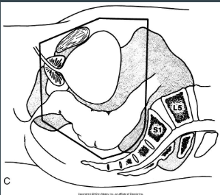 <p>extend 2 cm beyond bladder or any visable tumor/iliac nodes</p>