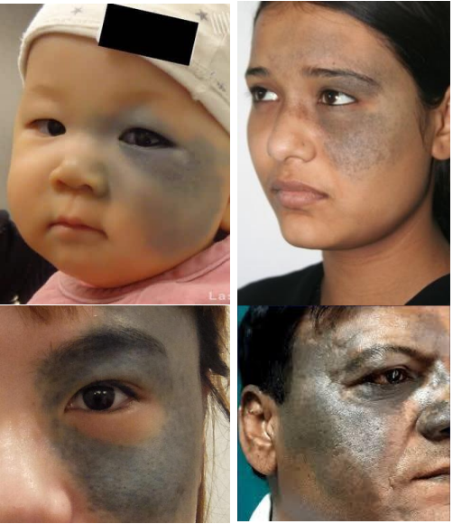 <ol><li><p><strong><u>Congenital </u></strong><u>pigmentation of periocular skin, uveal tract, sometimes orbits, meninges, and palate.</u></p></li></ol><p></p>