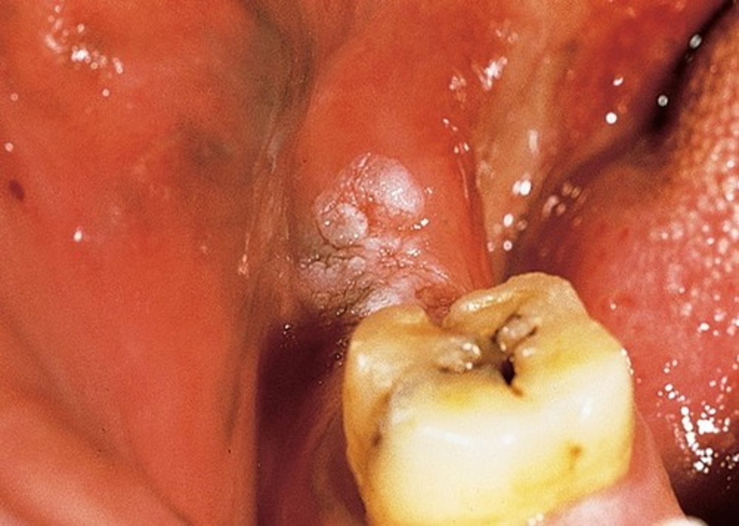 <p>"callus"</p><p>• close to source of irritation -- must be identified</p><p>• Common locations: tongue/cheek </p>