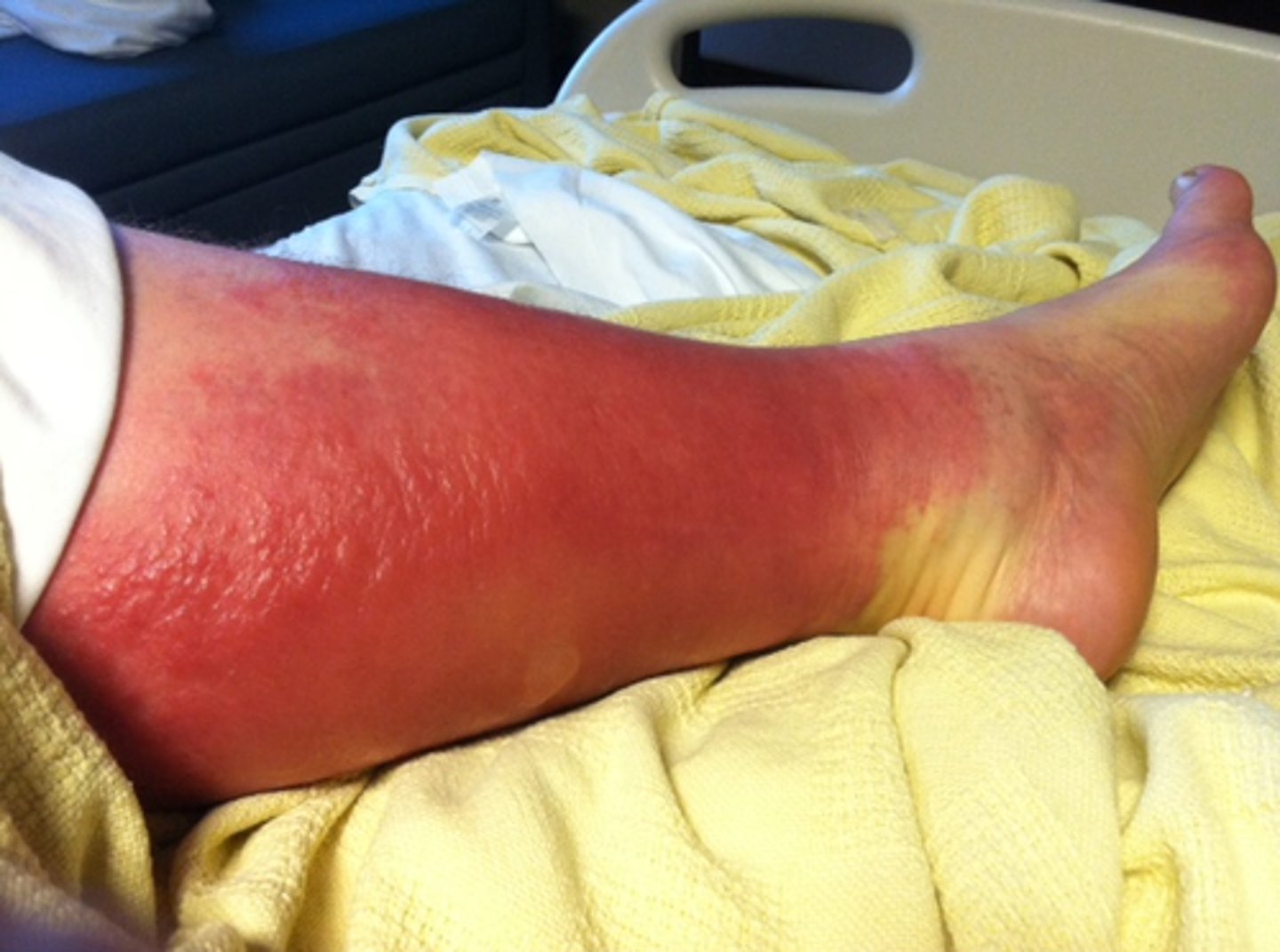 <p>-bacterial skin infection (strep, staph)</p><p>-affect skin swollen, inflamed, painful, warm to the touch</p><p>-goes to subcutaneous fat</p><p>-borders less defined</p><p>-usually affects lower legs, but can also occur on arms, face, etc</p><p>-antibiotics for treatment</p>
