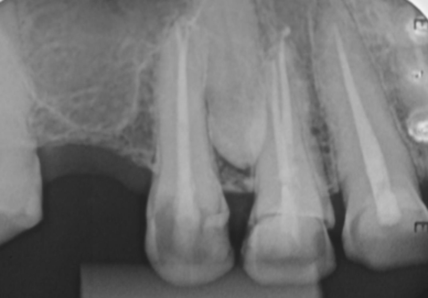 <p>AAE Terminology definition:</p><p>- A clinical diagnostic category indicating that the tooth has been endodontically treated and the canals are obturated with various filling materials other than intracanal medicaments.</p>