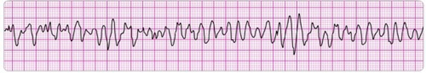 <p>Disorganized, ineffective twitching of the ventricles, resulting in no blood flow and a state of cardiac arrest.</p>