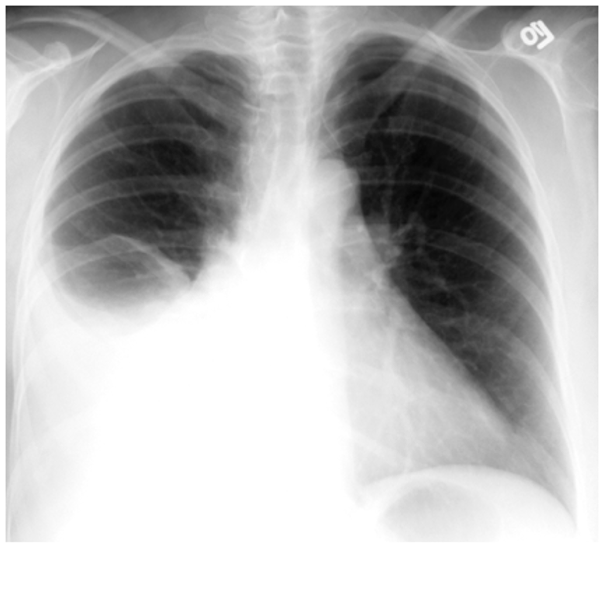 <p>a. pleural effusion.</p>