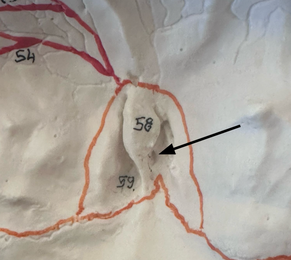 <p>What is the arrow pointing at, that is within the cribriform plates?</p>