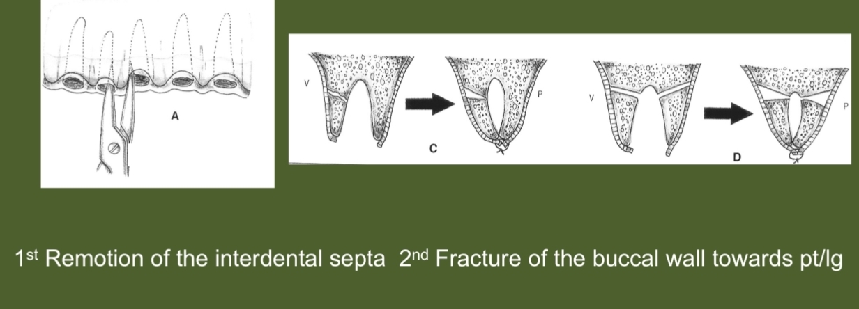 <p>Reduction of alveolar socket by compressing Bc cortical bone towards Lg/Pt alveolar wall after excision of interdental bone septa.</p>
