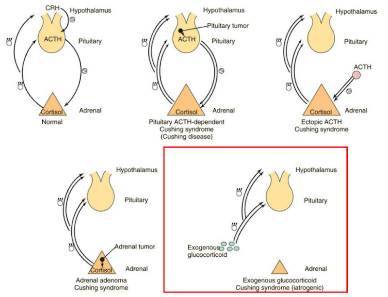 <ol><li><p><span><span>Pituitary tumor:</span></span></p></li></ol><ul><li><p><span><span>Overproduces ACTH → constant adrenal stimulation</span></span></p></li><li><p><span><u><span>Negative feedback fails → so high cortisol continues</span></u></span></p></li></ul><p></p><ol start="2"><li><p><span><span>Ectopic ACTH production (ex, small cell lung cancer):</span></span></p></li></ol><ul><li><p><span><span>ACTH produced outside pituitary</span></span></p></li><li><p><span><span>Stimulates adrenal gland → high cortisol</span></span></p></li></ul><p></p><ol start="3"><li><p><span><span>Adrenal tumor:</span></span></p></li></ol><ul><li><p><span><span>Tumor in adrenal gland → overproduction of cortisol</span></span></p></li><li><p><span><span>Independent of ACTH or CRH</span></span></p></li></ul><p></p><ol start="4"><li><p><span><span>Excess exogenous glucocorticoids (red box):</span></span></p></li></ol><ul><li><p><span><span>Long-term steroid use → oversaturation → same symptoms</span></span></p></li></ul><p></p>