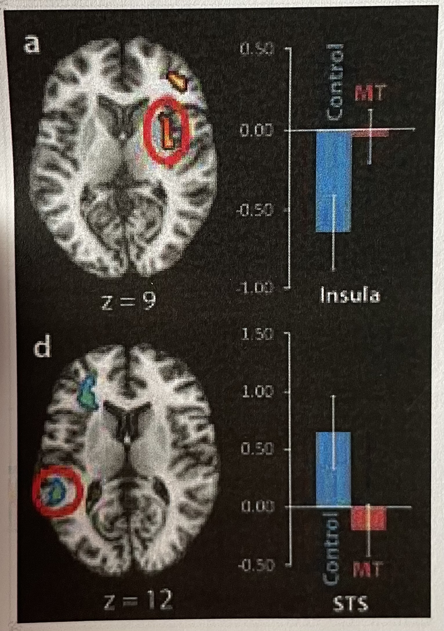 <p>Short Answer: Are there any differences between sad and neutral conditions in either of these brain areas for the mindfulness training (MT) group (i.e., is there any activation or deactivation)?</p>