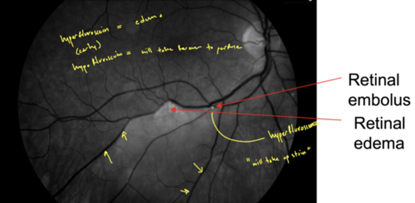 <p>hyperfluorescence (from edema) early on as occluded blood vessel leaks</p><p>then eventually hypofluorescence</p>