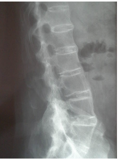 <p>Imaging findings of Ankylosing Spondylitis</p>