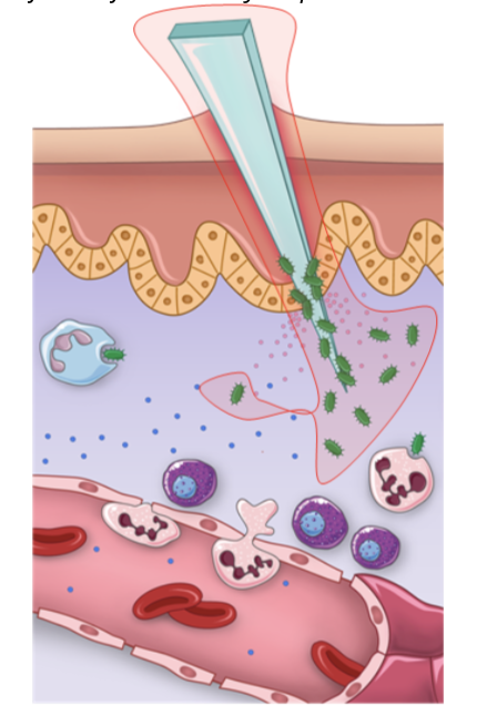 <ul><li><p>because the physical barrier is sealed, pathogens need to find a breach in order to be able to enter the body</p></li><li><p>this can happen in various ways, ie. a wound created by a nail or a piece of glass</p></li><li><p>an injury such as this will damage cells and give an opportunity for pathogens to break through the physical barrier</p></li></ul><p></p>