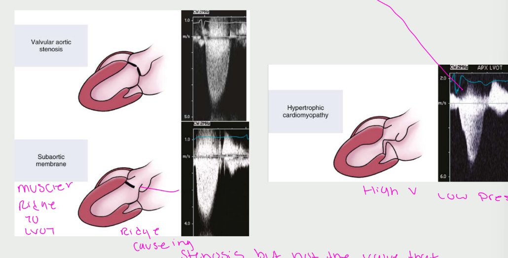 <p>Fixed subvalvular obstruction (a</p><p>subaortic membrane or a muscular</p><p>subaortic stenosis)</p><p>• Dynamic subaortic obstruction</p><p>(hypertrophic cardiomyopathy)</p><p>• Supravalvular stenosis</p>