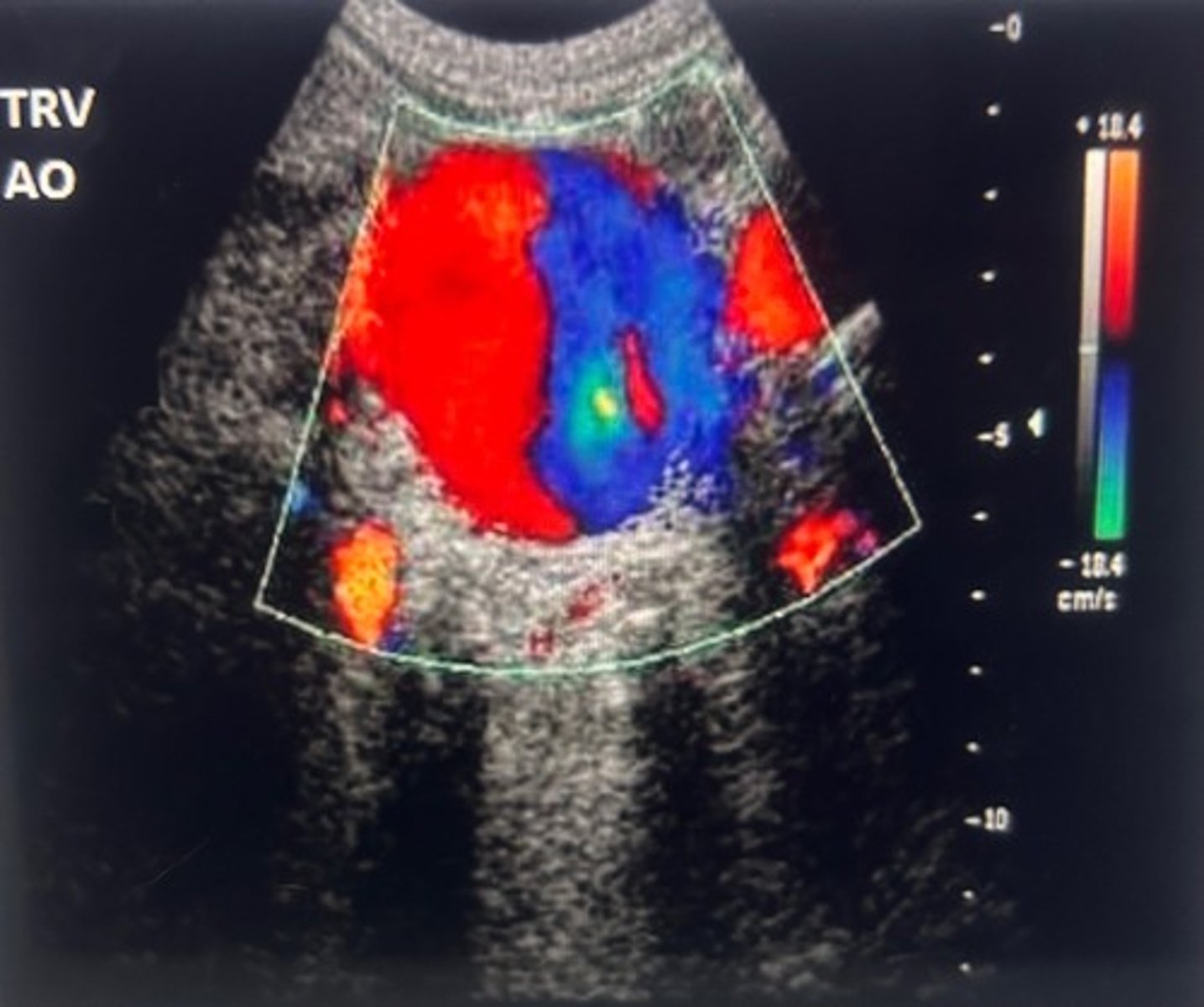 <p>Deep vein thrombosis</p><p>Embolism can occur as thrombus accumulate within the AAA and then breaks, loose to travel distally.</p><p>Blue toe syndrome occurs as an embolism travels to the most distal point (toes) and causes ischemia in the vessel area where it lodges. As the AAA grows the vessel, wall, things and weakeneds, causing a risk of rupture. DVT occurs within thrombus formation in the deep venous system.</p>