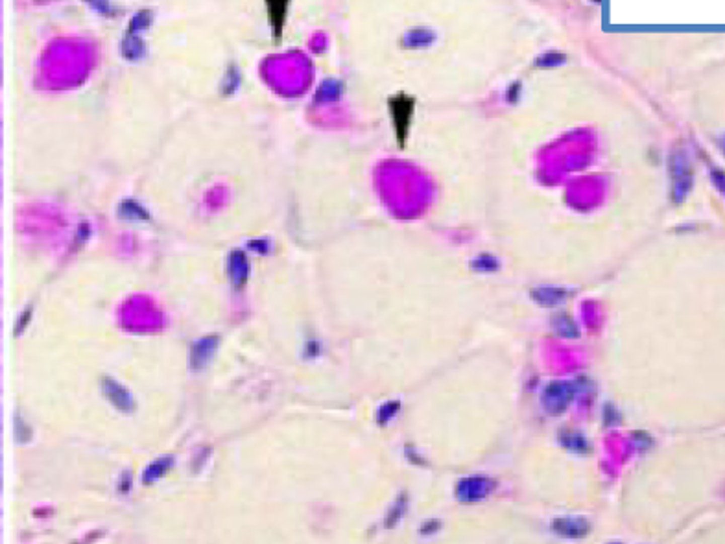 <p>What stain is used to dx GBE deficiency?</p>