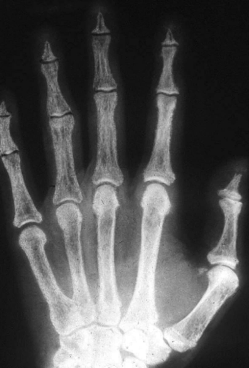 <p>Hands:</p><p>- resorption of tufts of terminal phalanges </p><p>– subperiosteal erosions of sides of phalanges</p><p>- localised lytic areas in shafts of long bone, ribs, jaw &amp; skull (brown tumours)</p>