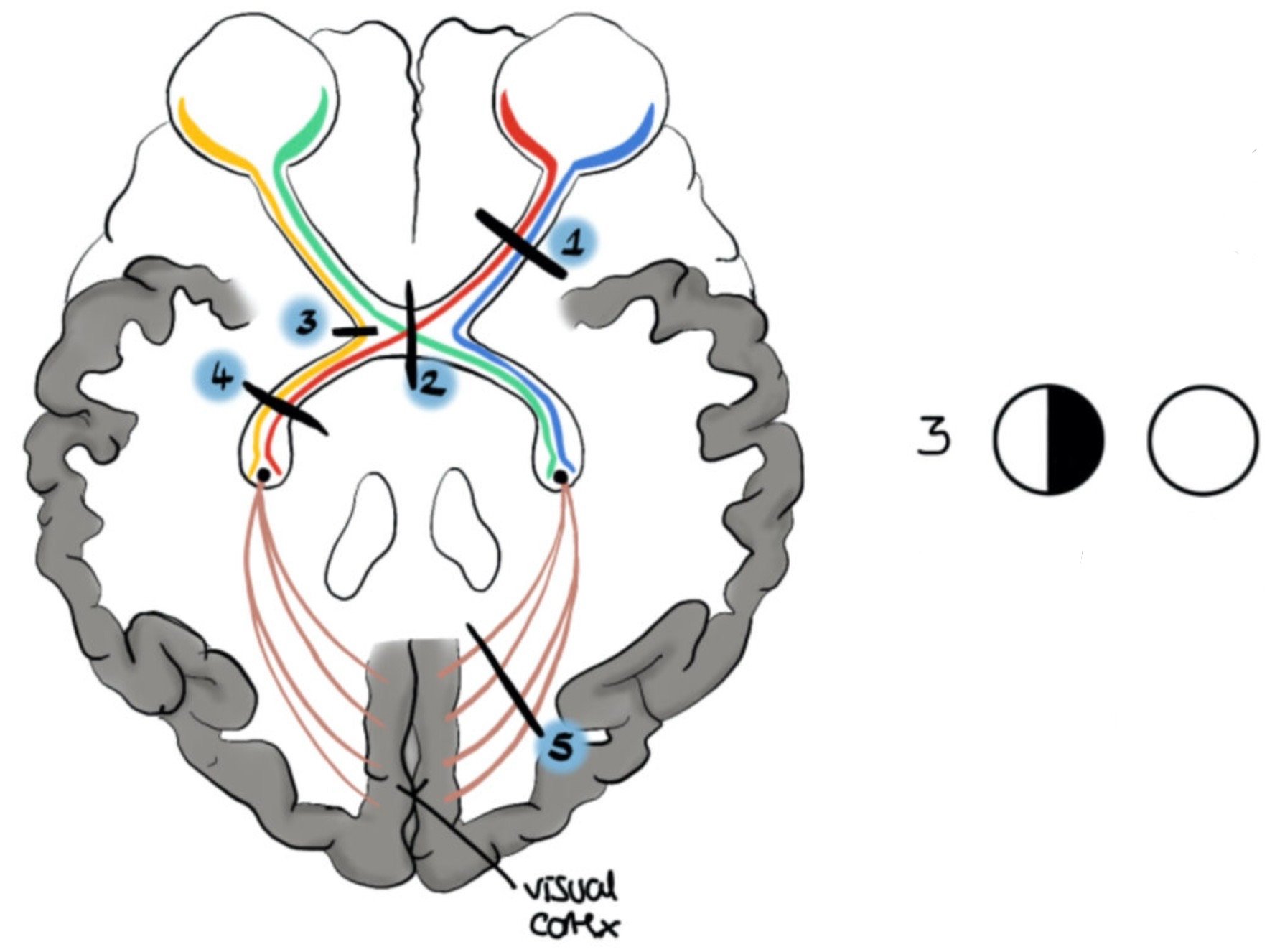 <p>What visual field defect is shown</p>