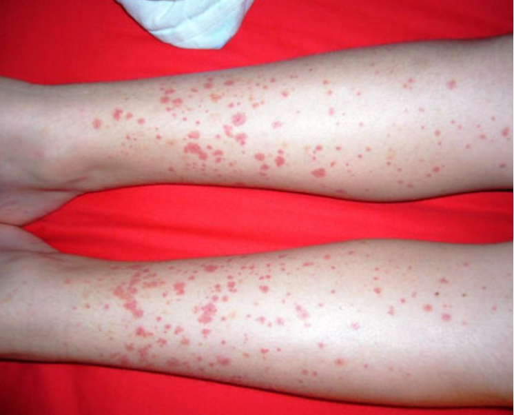 <ul><li><p>palpable purpura in pts w/ neither thrombocytopenia nor coagulopathy</p><ul><li><p>can be pruritic, rarely painful</p></li><li><p>rash begins as erythematous macular or urticarial wheals and progresses to petechia and palpable purpura</p></li></ul></li><li><p>arthritis/arthralgia</p></li><li><p>abd pain- can be assoc. w/ GI bleeding</p></li><li><p>renal dz</p></li><li><p>location- lower extrem, lesions appear symmetrical in crops</p></li></ul><p></p>