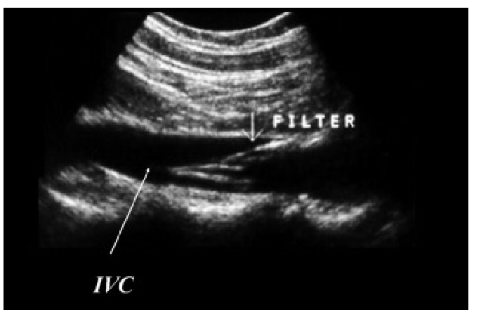 <p>Small device placed within proximal to mid abdominal IVC <strong>( just inferior to the renal veins)</strong> to catch thromboembolic particles before reaching the lungs and becoming a pulmonary emboli</p>