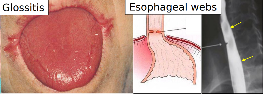 <ul><li><p>atrophic glossitis </p></li><li><p>esophageal webs </p></li><li><p>premalignant and associated w oral and esophageal SCC </p></li></ul><p></p>