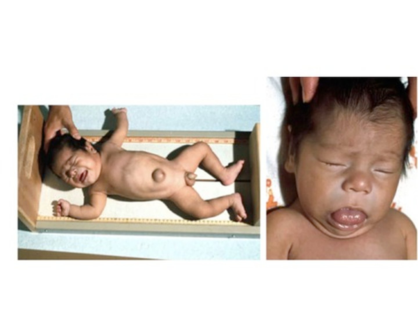<p>Define Condition:</p><p>Thyroid Hormone deficiency AT BIRTH; Most Common TREATABLE CAUSE of Intellectual Disability</p><p>-Hx:</p><p>&gt; Thyroid dysgenesis (abnormal gland developmet)</p><p>&gt; Dyshormonogenesis (abnormal TH synthesis), ex = mutations in thyroid peroxidase</p><p>&gt; Iodine Deficiency in mother during pregnancy</p><p>-Tx: Supplemental TH therapy</p><p>-Sx/PE/Prog: (if no Tx) = 6 Ps</p><p>&gt; Pot bellied</p><p>&gt; Puffy-faced (coarse facial features)</p><p>&gt; Protruding umbilicus (umbilical hernia)</p><p>&gt; Protuberant tongue (macroglossia)</p><p>&gt; Poor brain development (poor myelin sheath development)</p><p>&gt; Poor bone growth (short stature)</p>