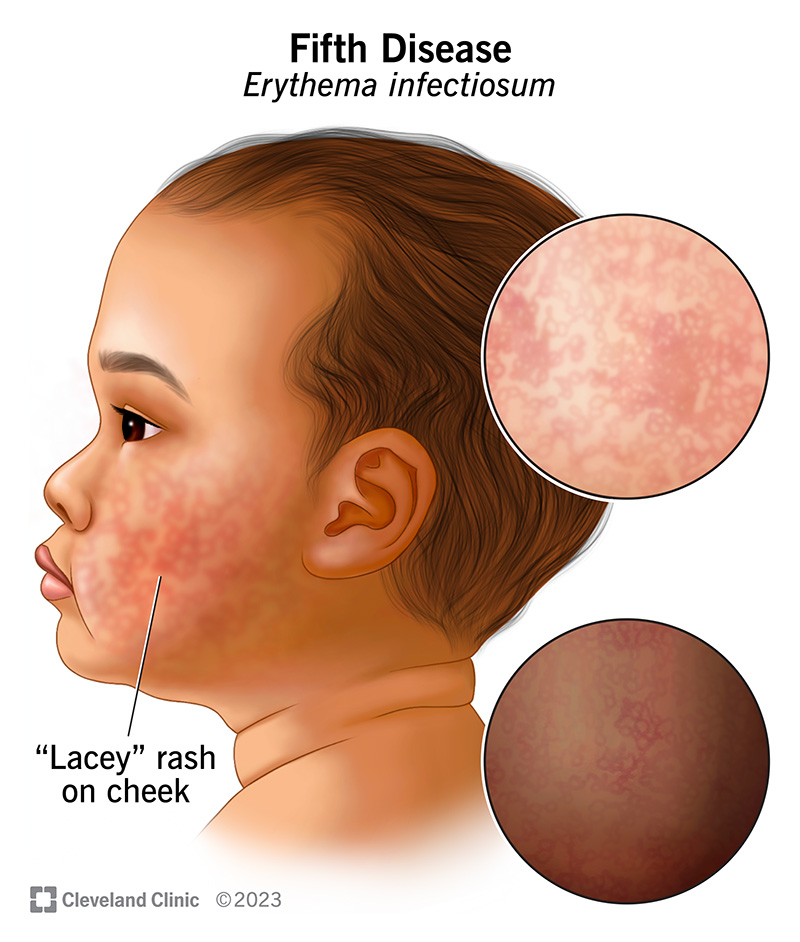 <p><strong>Erythema infectiosum</strong>, also known as <strong>“fifth disease”</strong></p><p><em>A childhood exanthem (rash).</em></p>